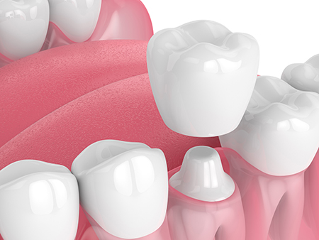 The image displays a collection of white teeth with pink gums against a plain background.