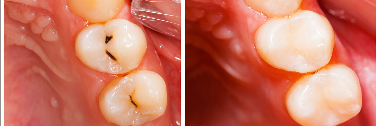 The image displays a close-up view of a human tooth with visible decay and cavities, set against a blurred background that suggests an oral cavity setting.