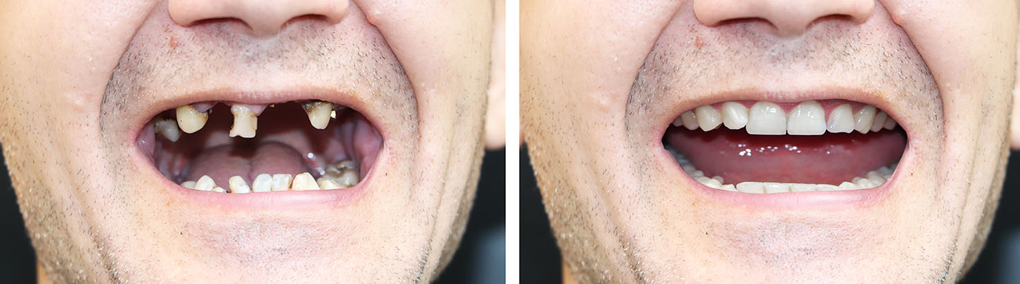 The image shows a composite of four different facial expressions with a person s mouth open, each displaying a unique tooth condition, set against a gray background.