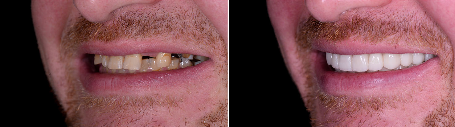 The image features a person with two different smiles, showcasing their teeth, presented side by side.
